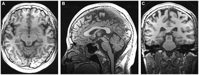 Altered metabolites in the periaqueductal gray of COVID-19 patients experiencing headaches: a longitudinal MRS study